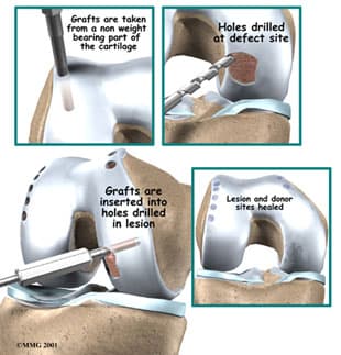 Knee Cartilage Transplant in Kirkland WA