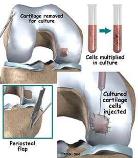 Knee Cartilage Treatment Kirkland, WA