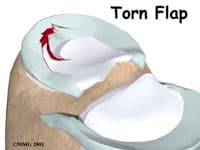Torn Meniscus Surgery