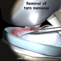 Partial Meniscectomy in Seattle 