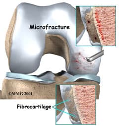 Knee Microfracture in Kirkland WA