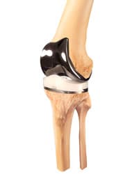 Knee Replacement Kirkland, WA