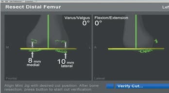 Knee Replacement 3D Imaging