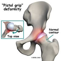 Hip FAI Treatment Kirkland, WA