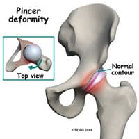 FAI Hip Surgery in Kirkland