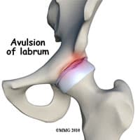 Hip Labral Tear Repair Kirkland, WA