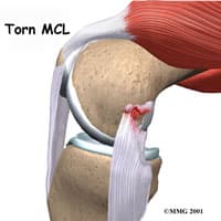 MCL Knee Surgery Seattle